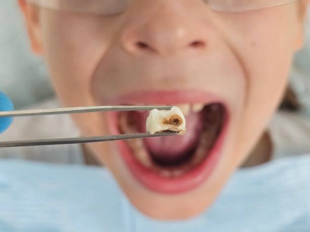 Best Urgent Care for Lost Fillings or Crowns in Shil, OH